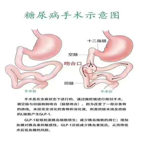 配资快线 国家卫健委为何禁止这一“糖尿病手术”？